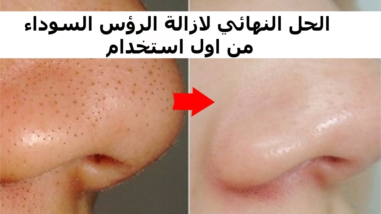 علاج الرؤوس السوداء في الأنف نهائياً