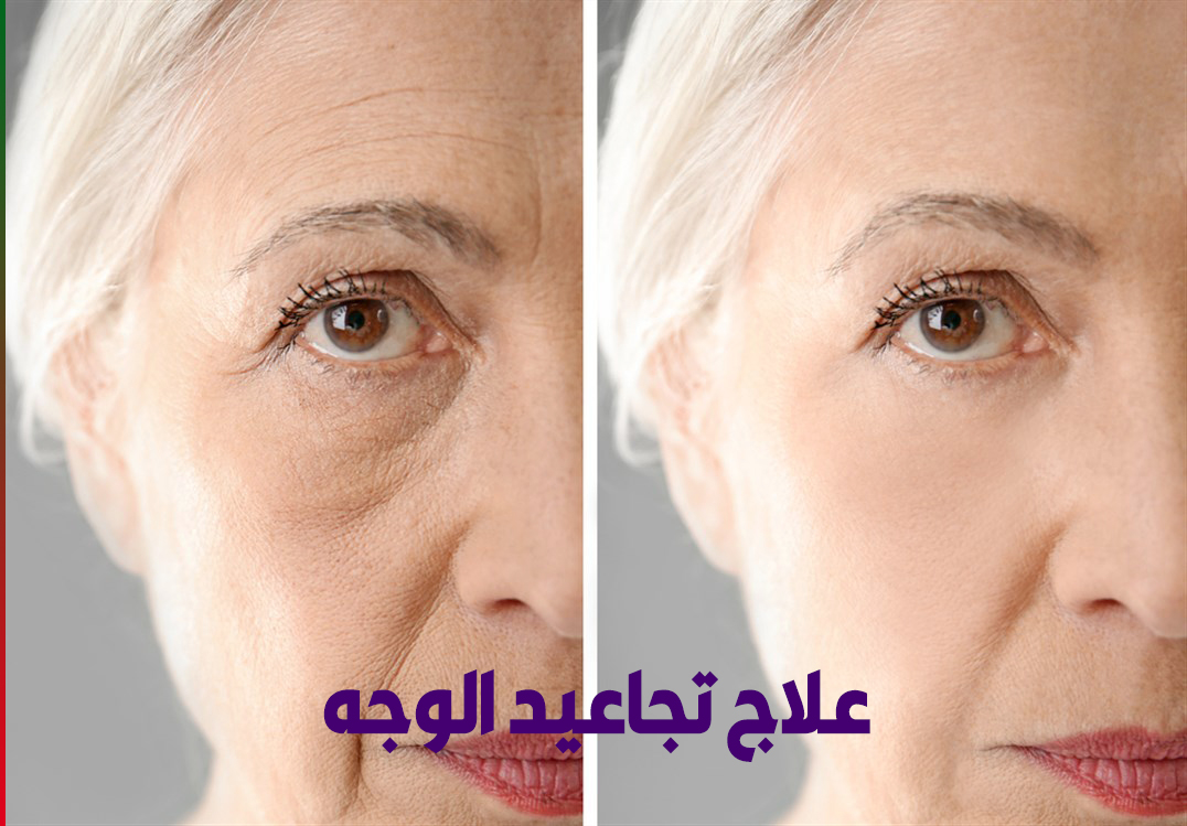 علاج تجاعيد الوجه