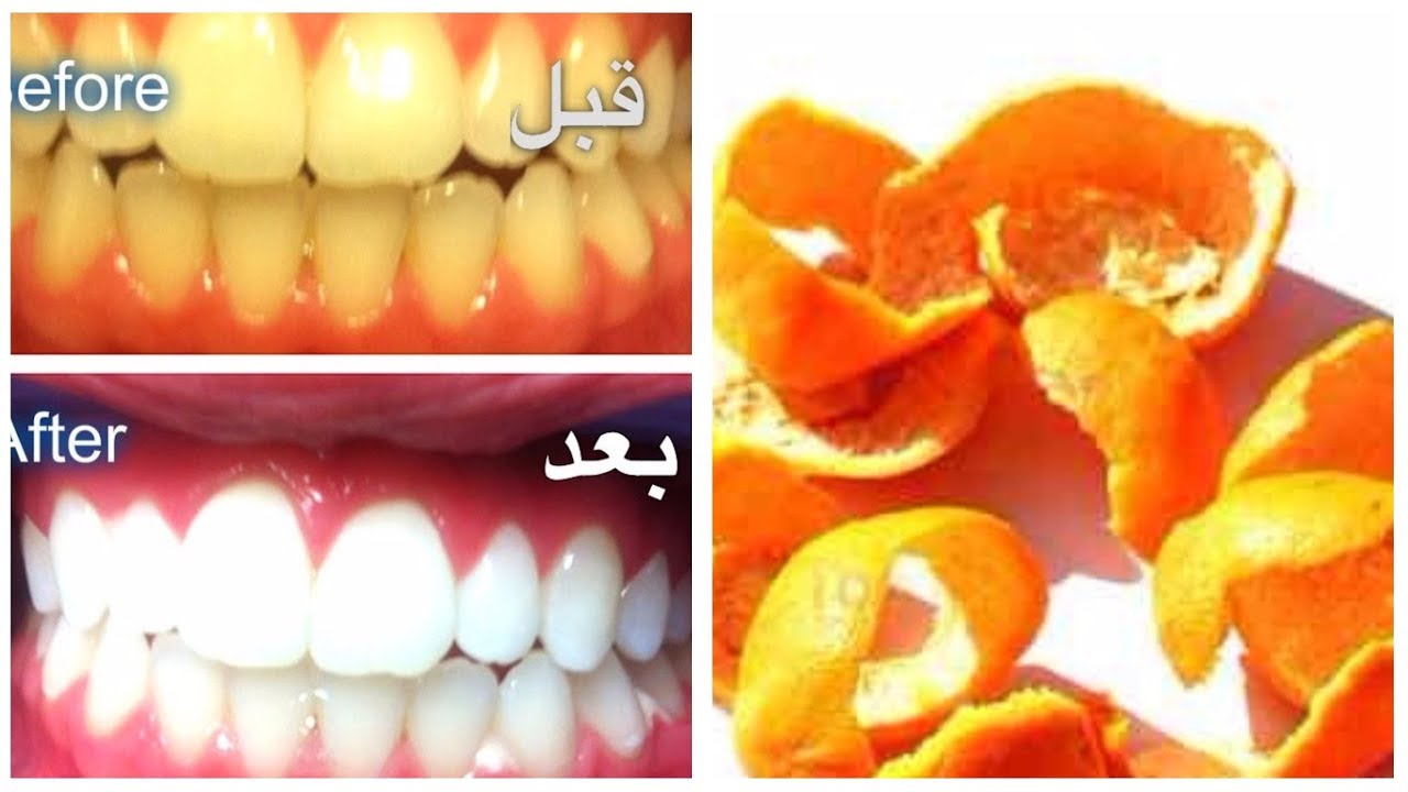 قشور البرتقال لتبييض الأسنان