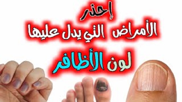 الأظافر المخططة