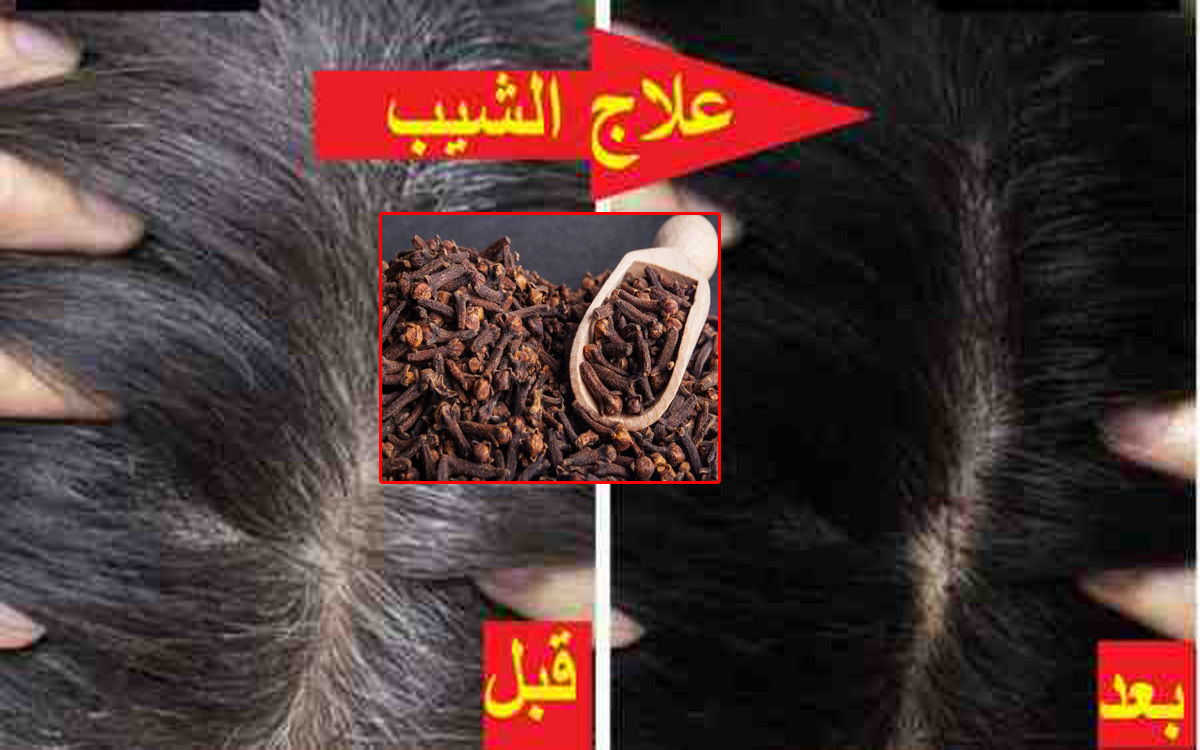 هاتي القرنفل وتعالي اقولك على طريقة التخلص من الشعر الأبيض