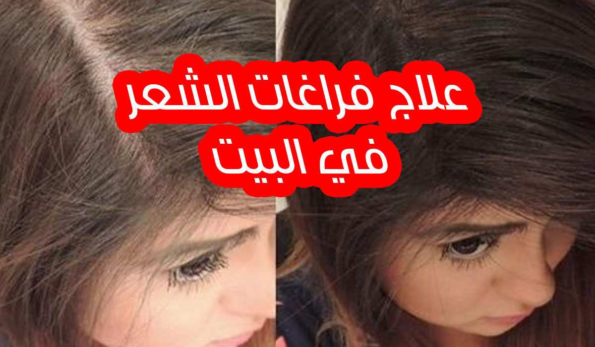 تكثيف الشعر