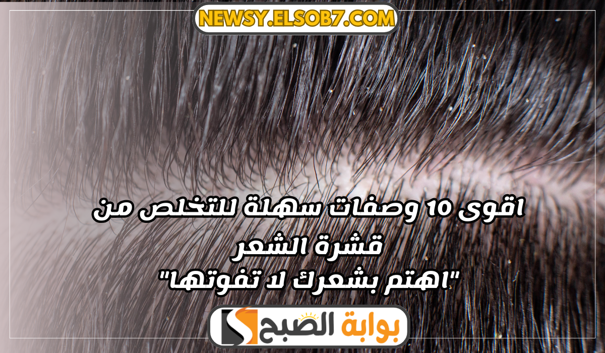 وصفات سهلة للتخلص من قشرة الشعر