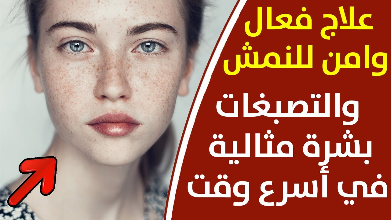 وصفات لإزالة النمش وتفتيح البشرة