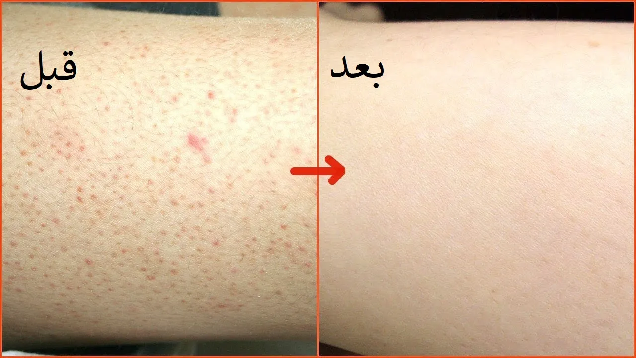 وصفات لعلاج جلد الوزة