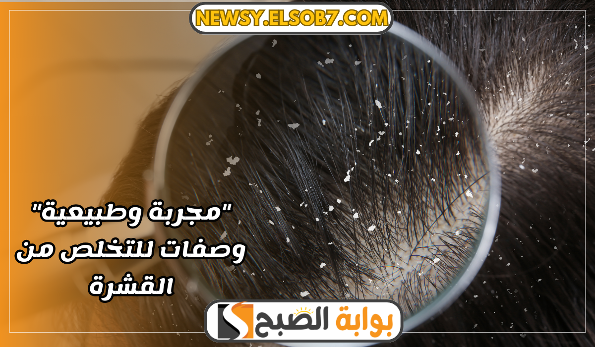 وصفات للتخلص من القشرة