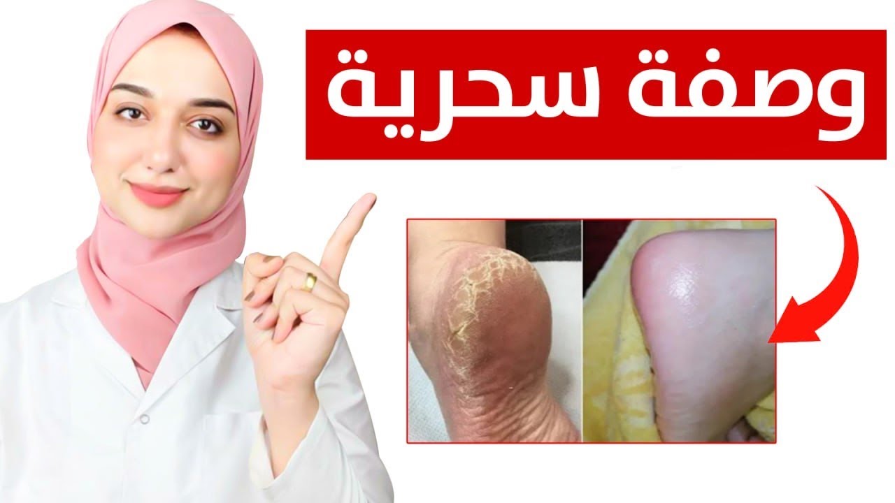 وصفة الخل لتشقق للقدمين
