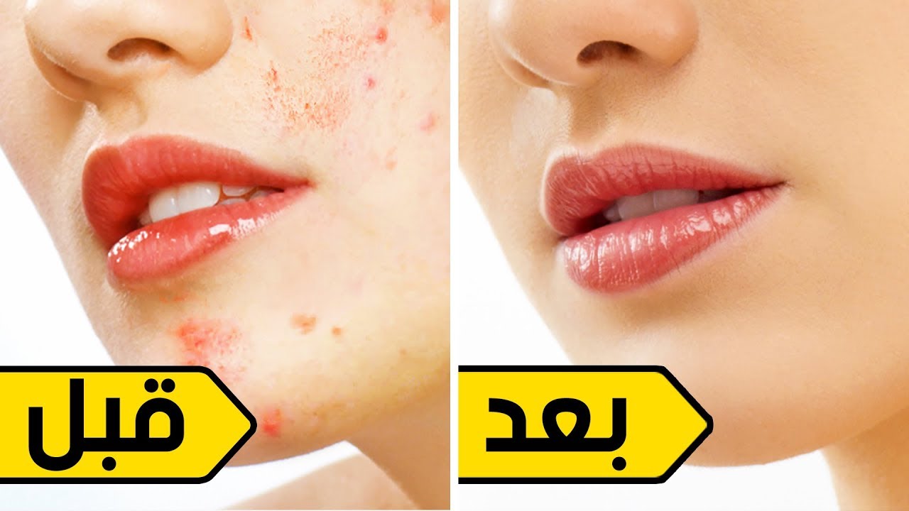وصفة لإزالة الحبوب من الوجه في يوم واحد