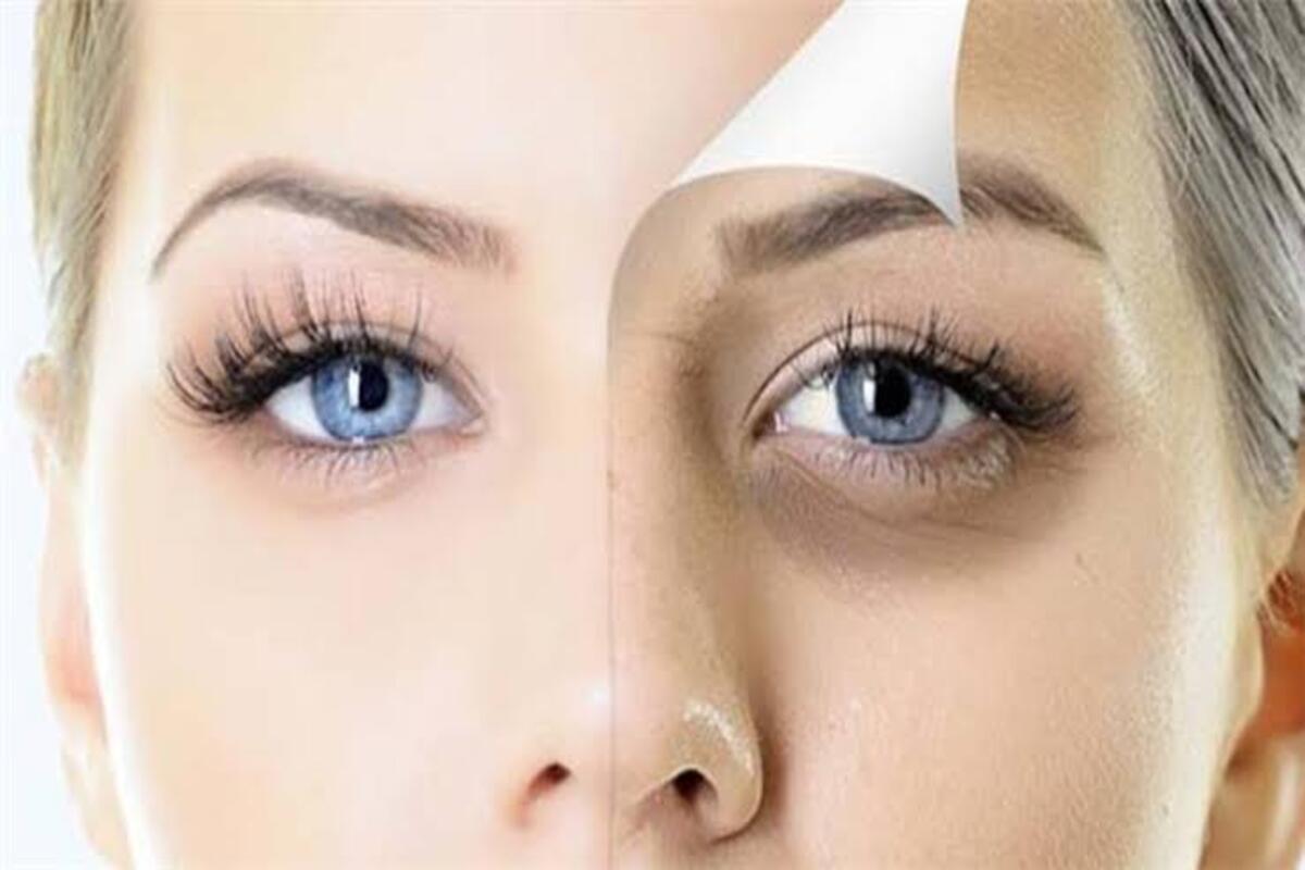 طرق التخلص من الهالات السوداء بمكونات في بيتك تخلصي منها