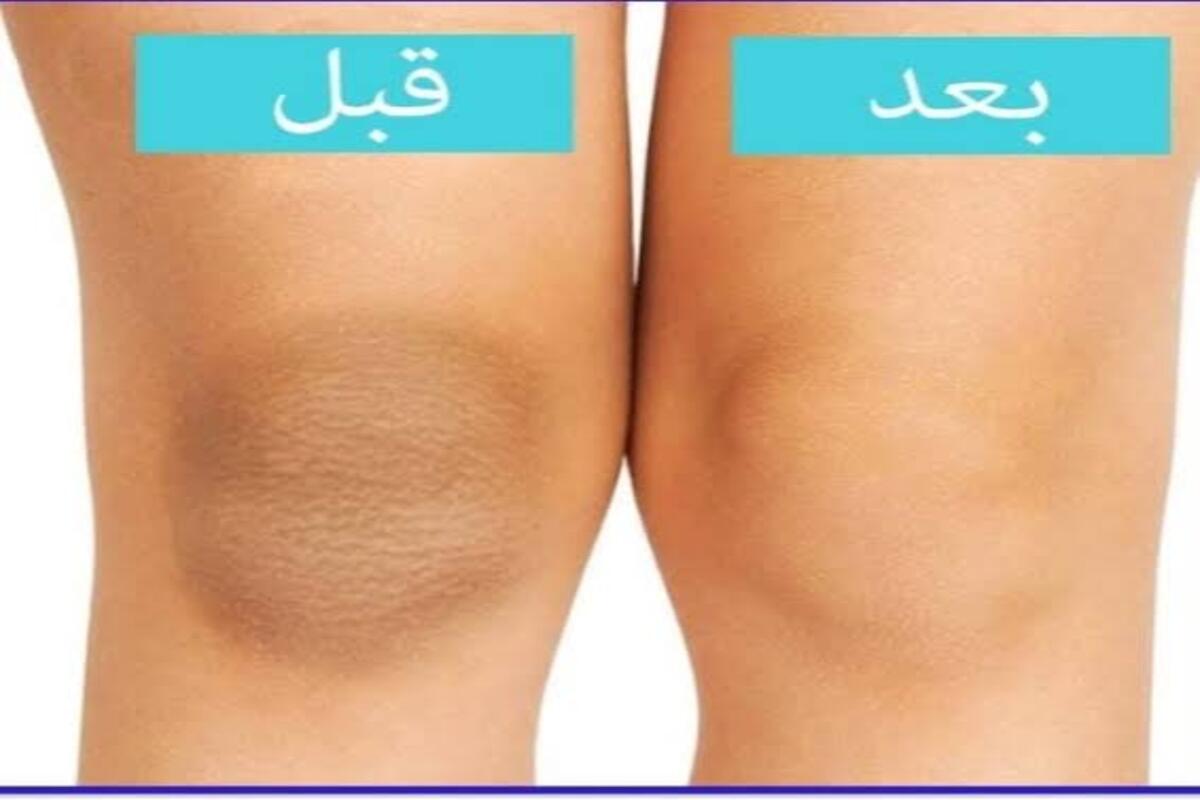 وصفة تبييض الركبتين مضمونة