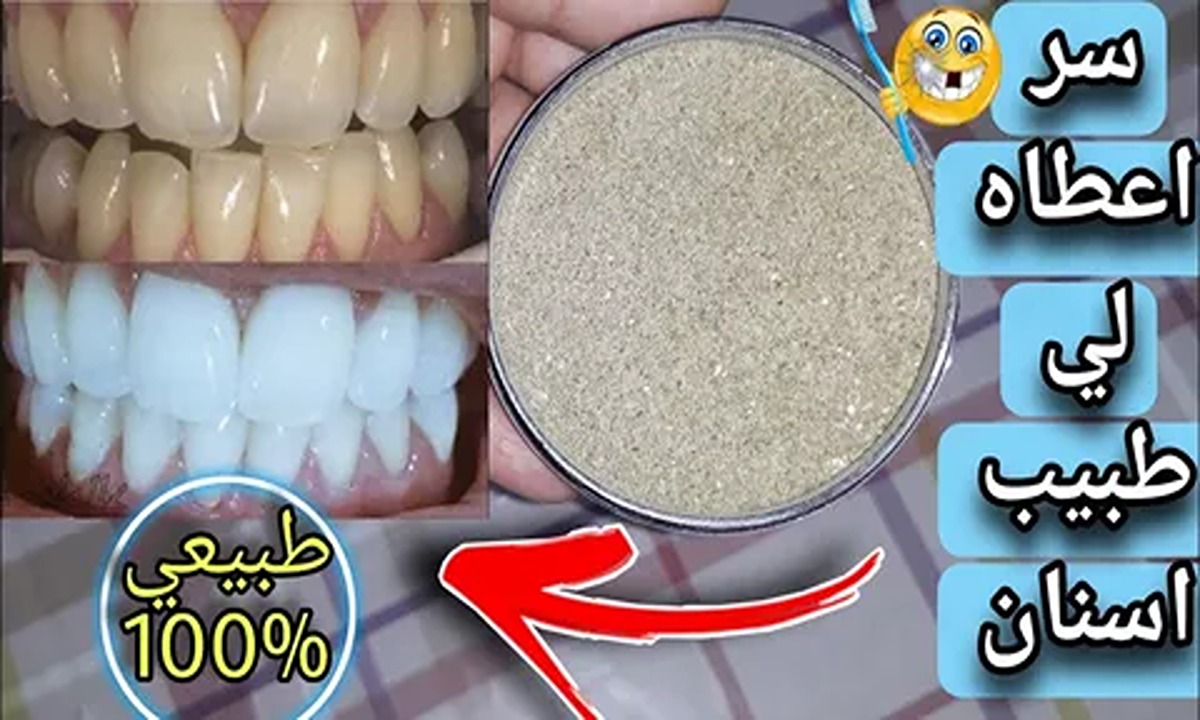 طريق تبييض الاسنان