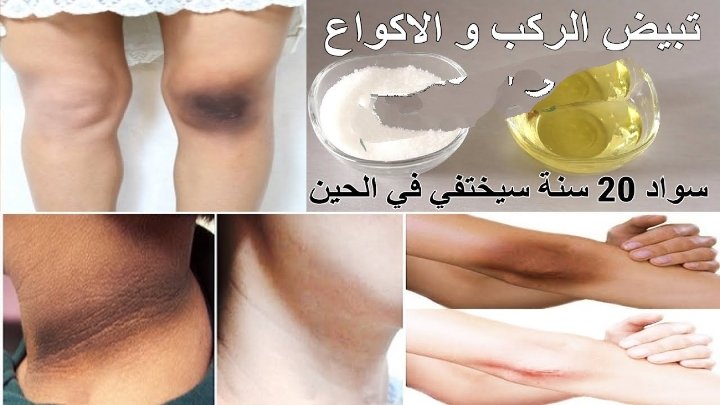 طرق طبيعية لتبييض وتقشير الركب والأكواع وإزالة التصبغات الداكنة بنتائج فورية من أول استعمال