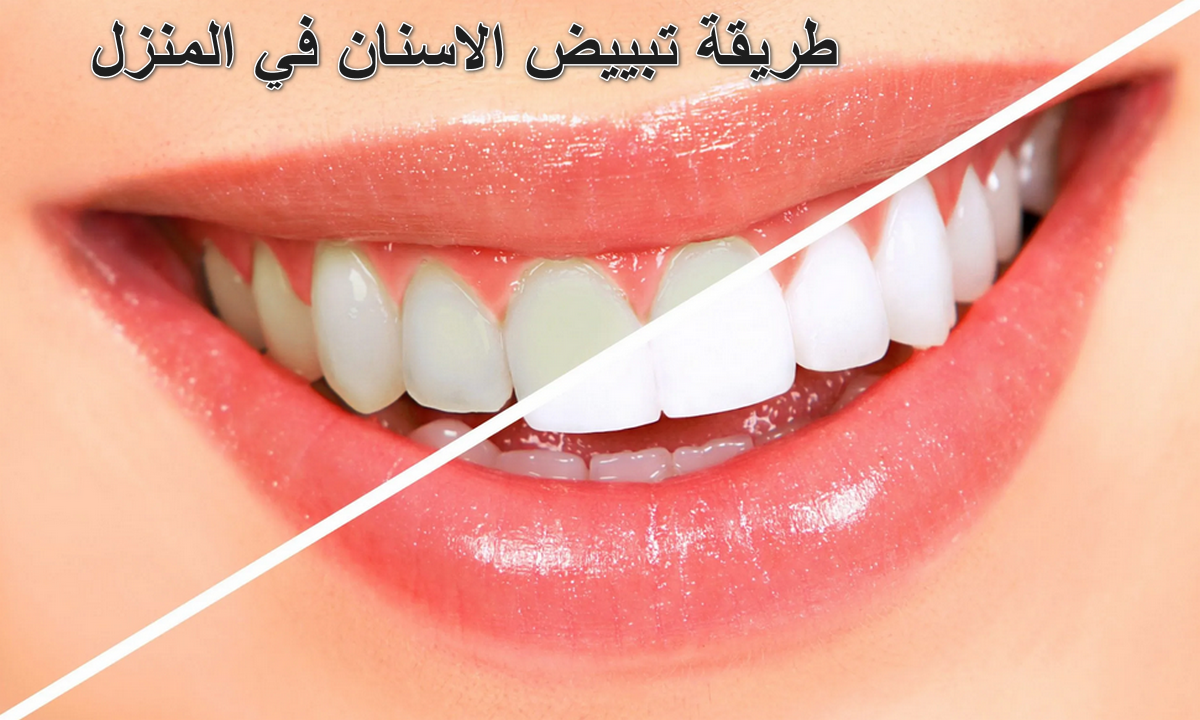طريقة تبييض الاسنان في المنزل