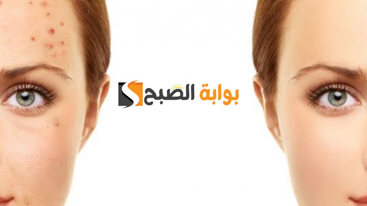 ‏خلي وشك زي البلور.. ماسك طبيعي من دقيق القمح لإزالة حب الشباب لأصحاب البشرة الدهنية والنتيجة واضحة من أول استخدام "بشرتك هتبقى زجاجية"
