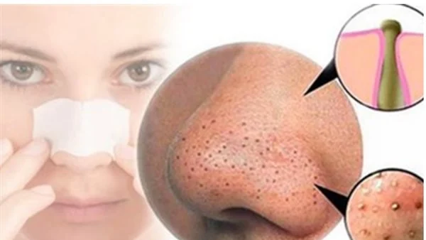أهم الأقنعة الطبيعية لتنظيف الوجه والأنف من الرؤوس السوداء وتصغير المسام بنتائج سريعة وآمنة