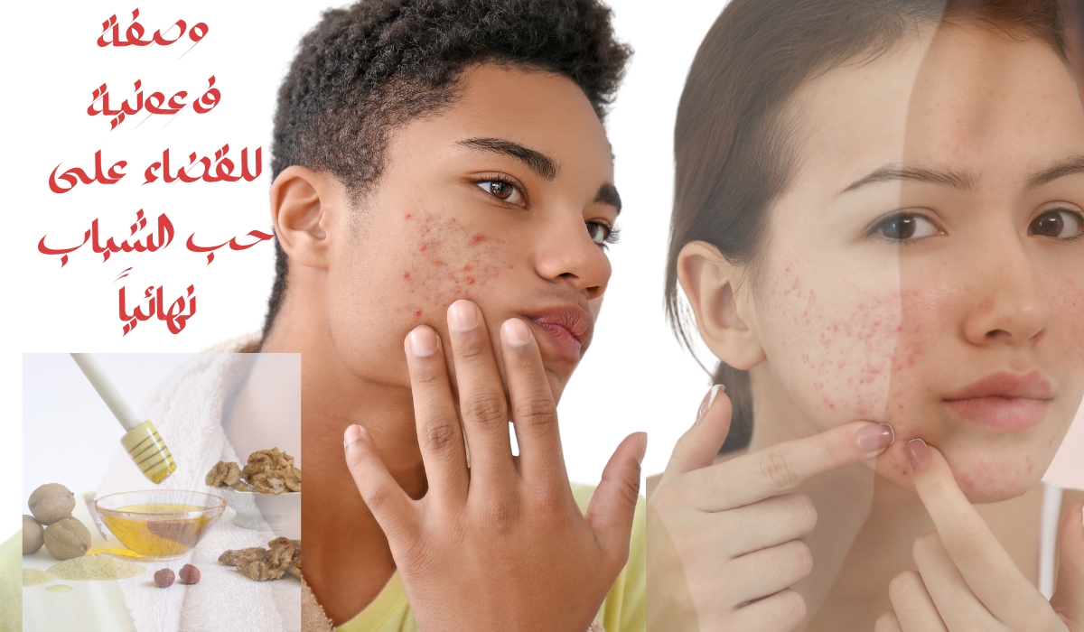 بثلاث مكونات فقط وصفة فرعونية لعلاج حب الشباب وإزالة أثاره