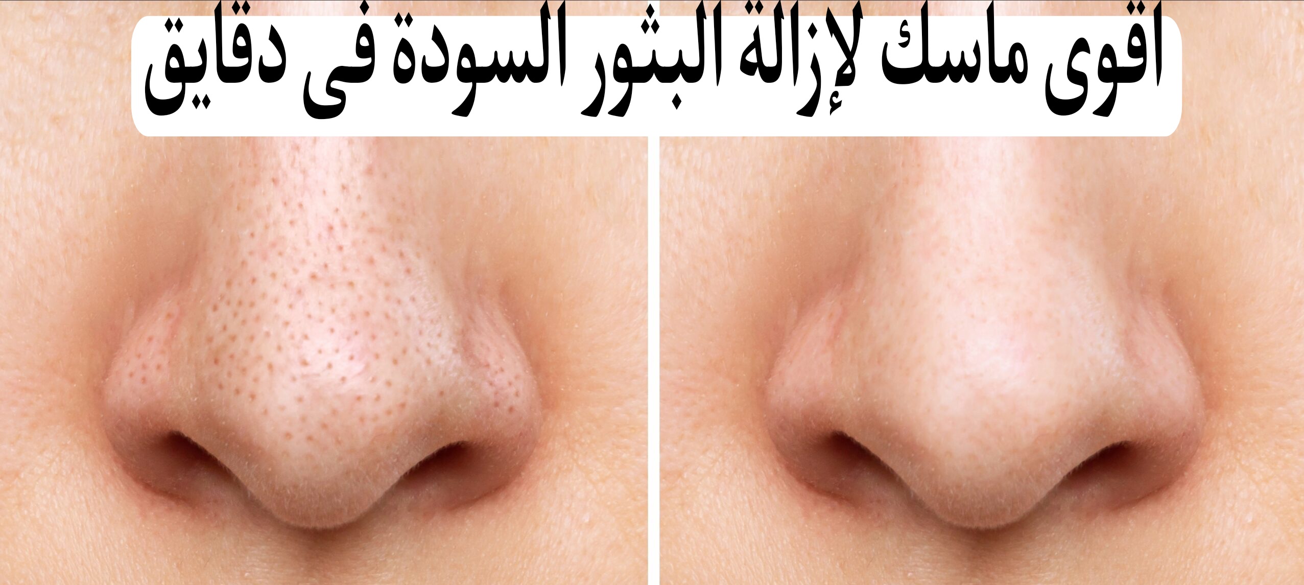 أقوى ماسك لإزالة البثور السودة