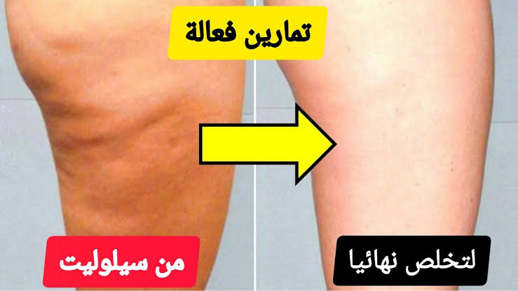 مكون واحد من مطبخك لعلاج السيلوليت والترهلات نهائيا في 14 يوم وتغيير الجلد 180 درجة
