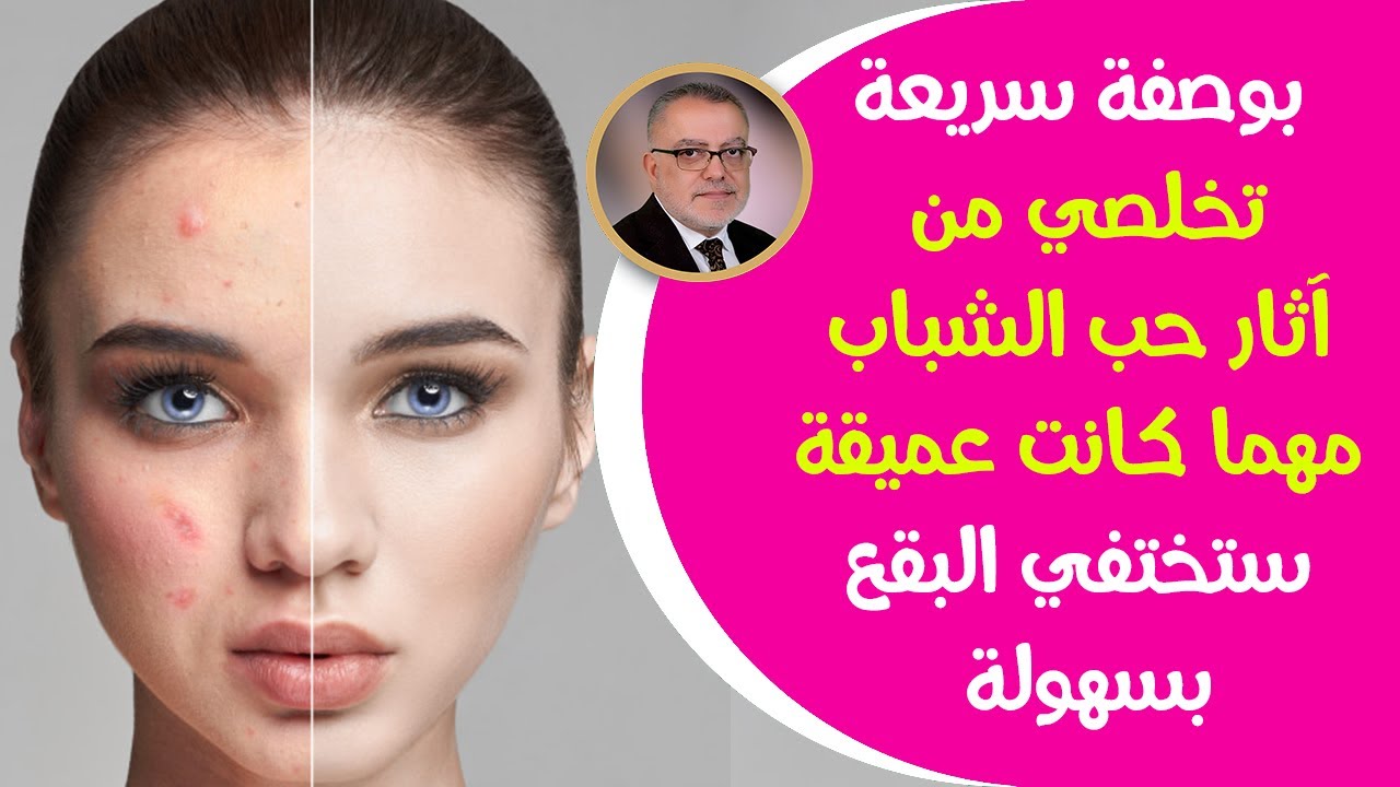 تفتيح البشرة وإزالة الحبوب