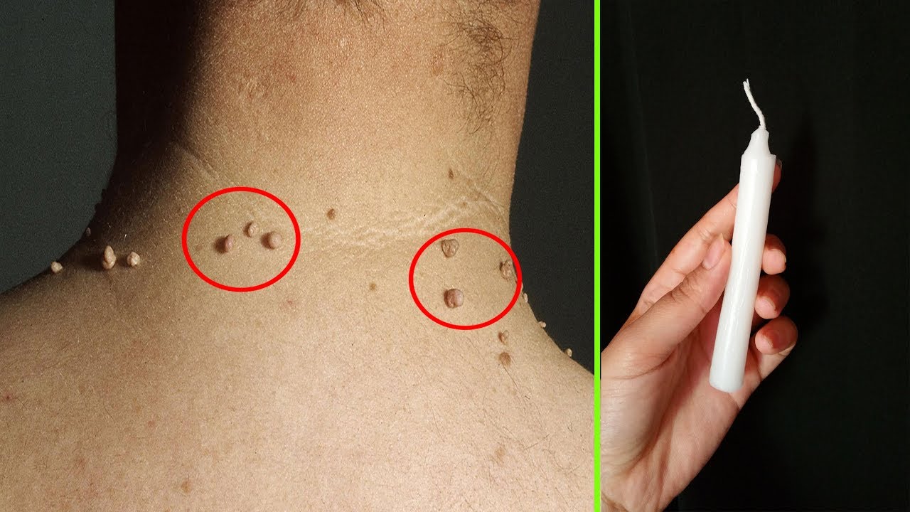 مسحة واحدة ستخلصك من الزوائد الجلدية أو الثالول في أقل من 5 دقائق مهما كان حجمها واستحالة تظهر مجددا