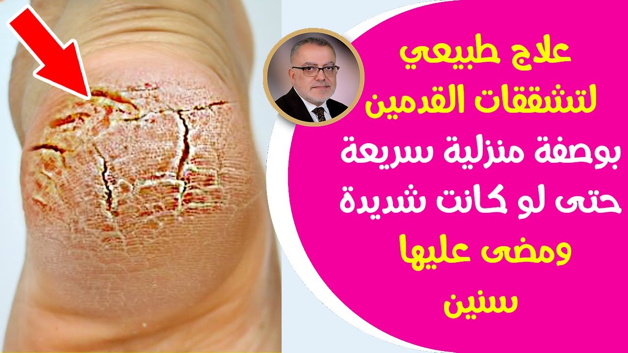 تشققات القدم الشديدة