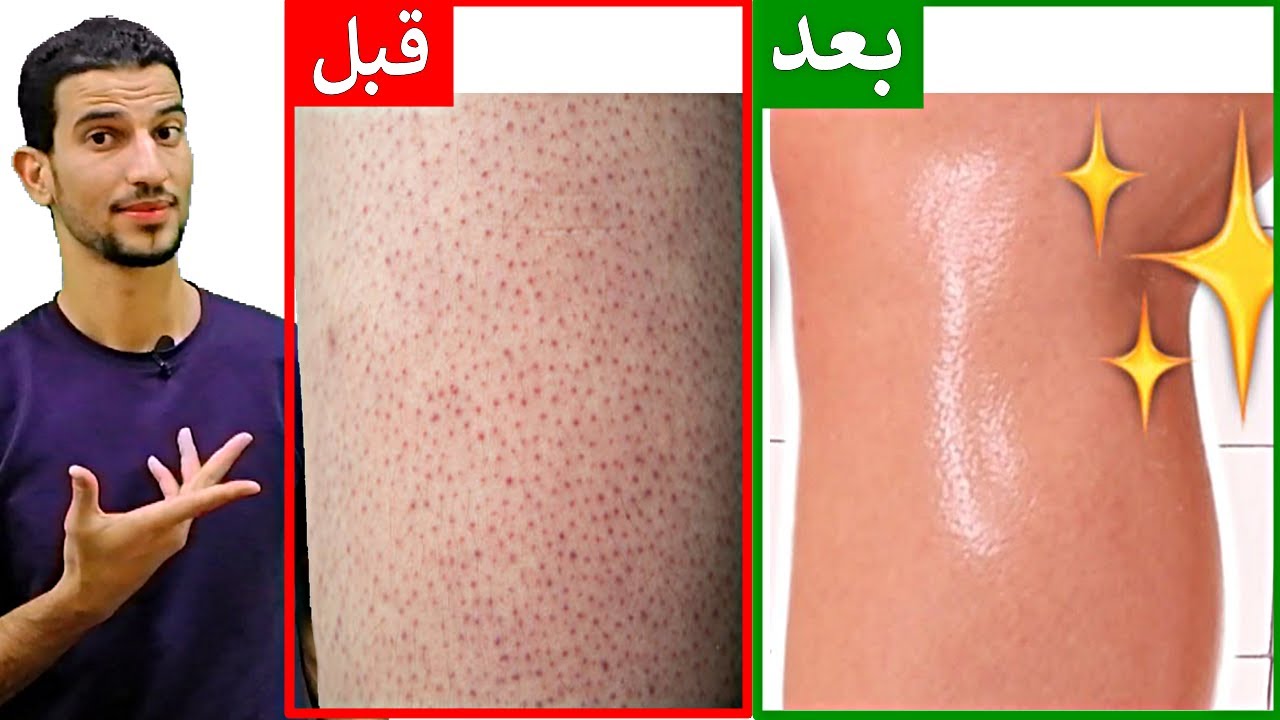 وصفات طبيعية لعلاج جلد الوزة بالساقين