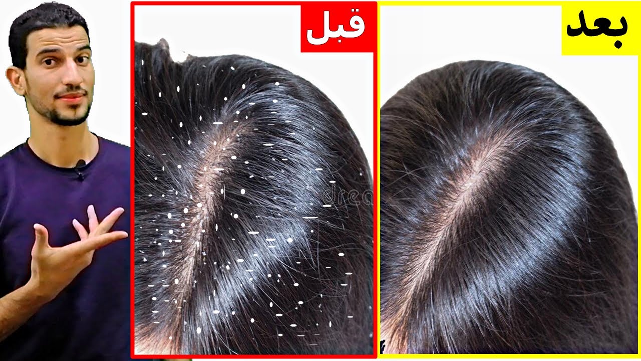 "وداعا للإحراج" طريقة علاج قشرة الشعر نهائيا والاستمتاع بشعر لامع وصحي