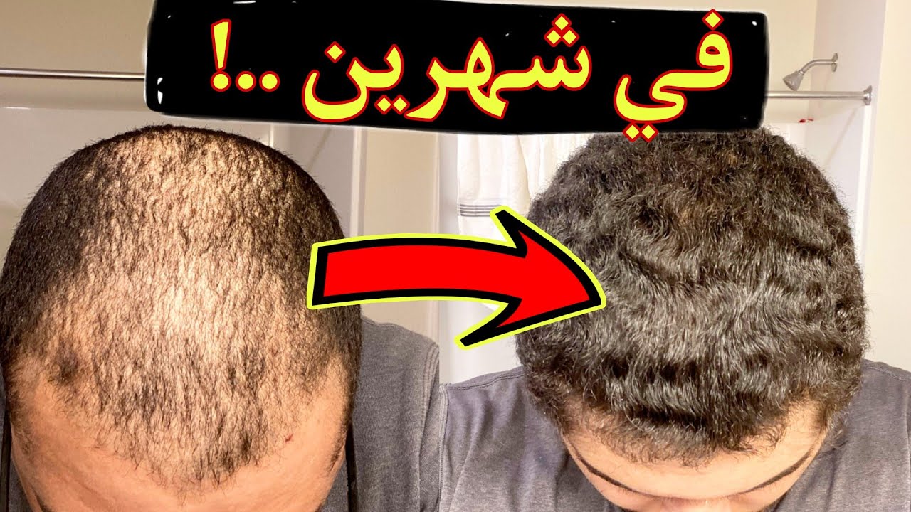 محلول منزلي ينبت فراغات