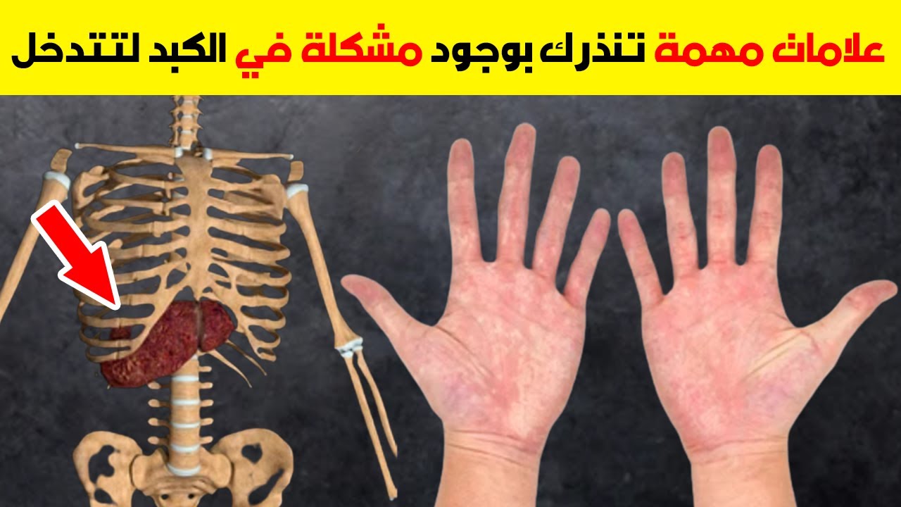 الأطباء يحذرون علامات تدل على أن الكبد ملئ بالسموم ويجب الذهاب فورا للطبيب قبل فوات الأوان
