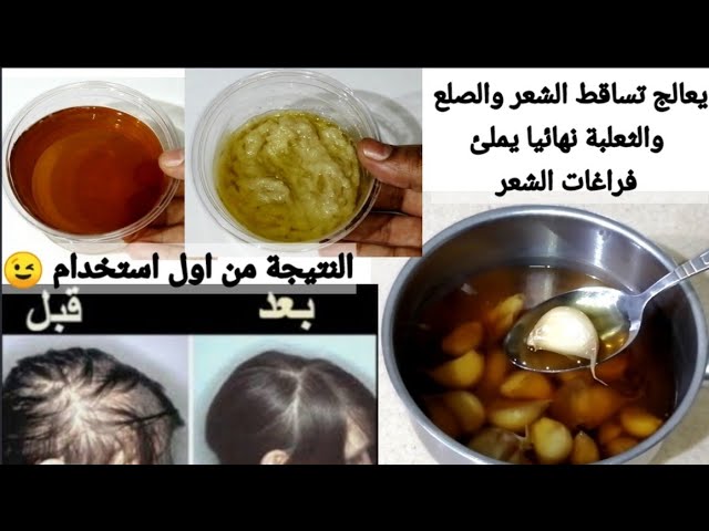 خلطة الثوم والقرنفل لعلاج تساقط الشعر ضعيها علي فراغات الشعر ينبت من جديد تعالج الصلع الثعلبة نهائيا