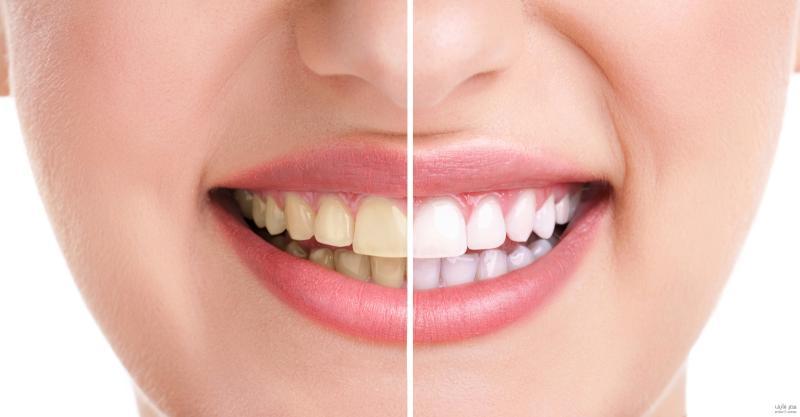 teeth whitening