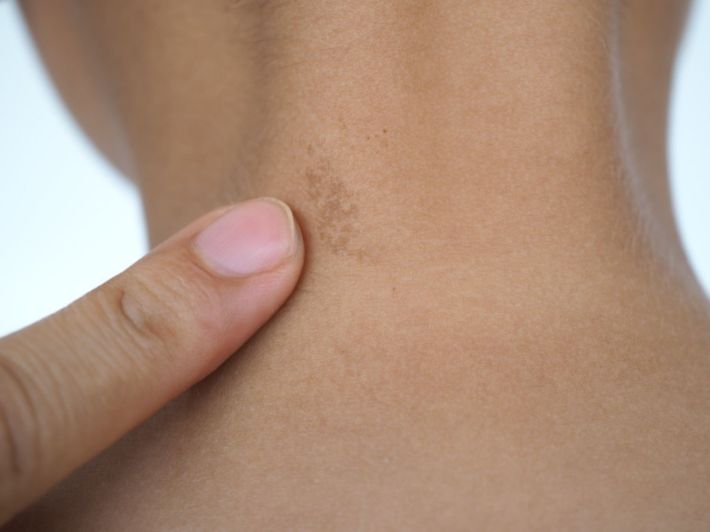 أسباب سواد الرقبة عند الأطفال