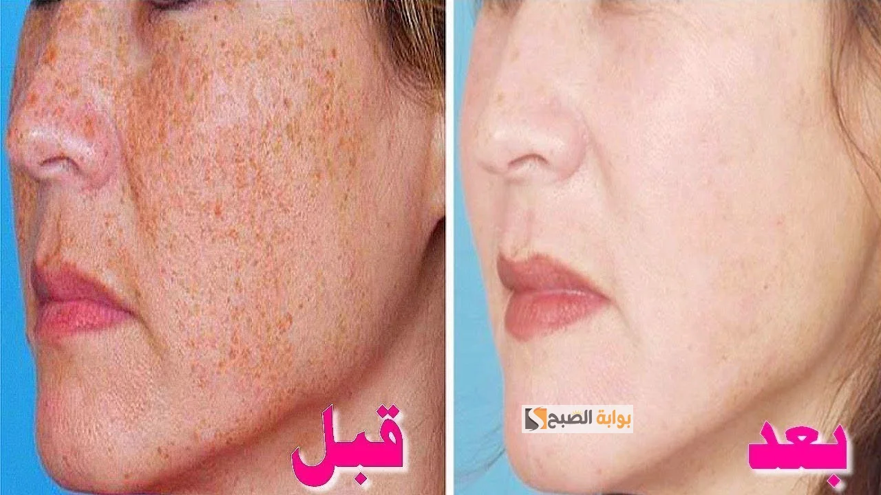 إزالة الكلف والنمش