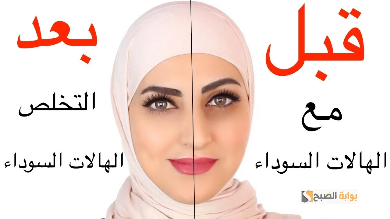 التخلص من الهالات السوداء