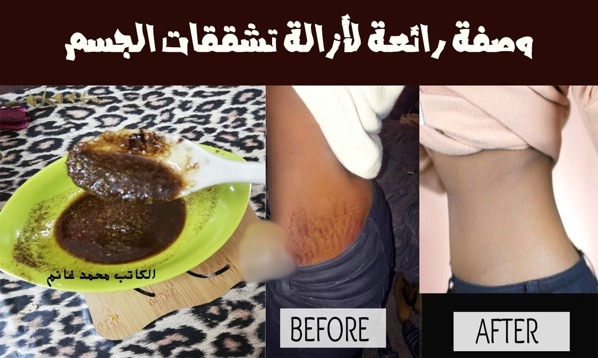 هتزغللي عيون زوجك.. خليط من القهوة وزيت الزيتون الحل السحري للتخلص من علامات تمدد الجلد "وفري فلوس الجلسات"