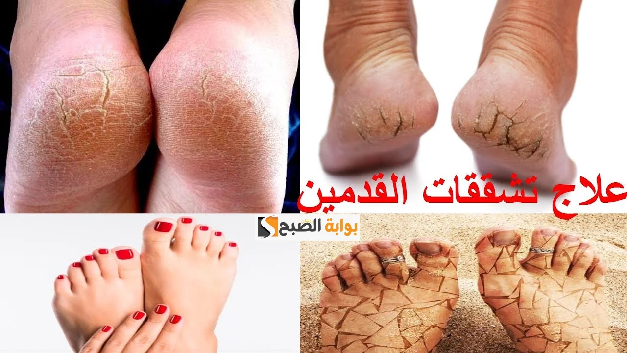 تشققات القدمين والجلد في فصل الشتاء