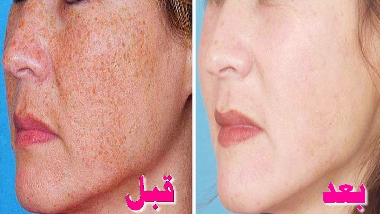 تقشير الكلف في البيت