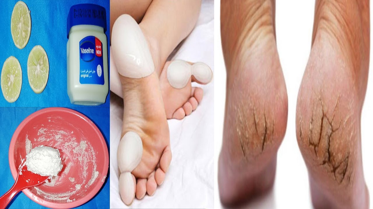 سأحضر ملعقة من النشا وأخبرك بسر النشا للتخلص من تشقق