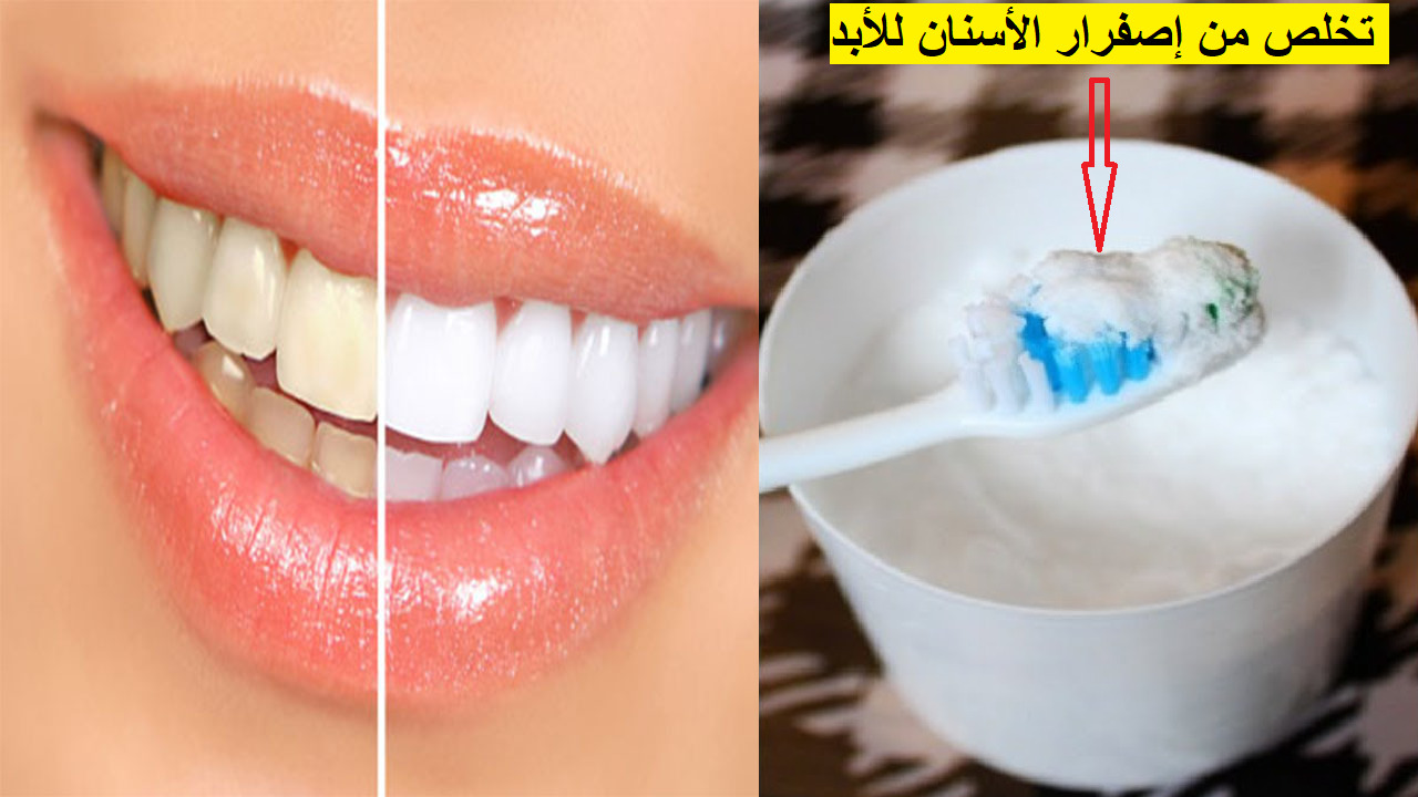 وصفة للتخلص من اصفرار الأسنان والجير نهائيا في المنزل بطرق طبيعية وإعادة الابتسامة البيضاء