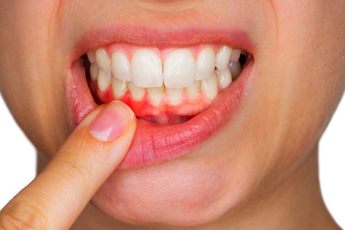 علاج التهابات اللثة