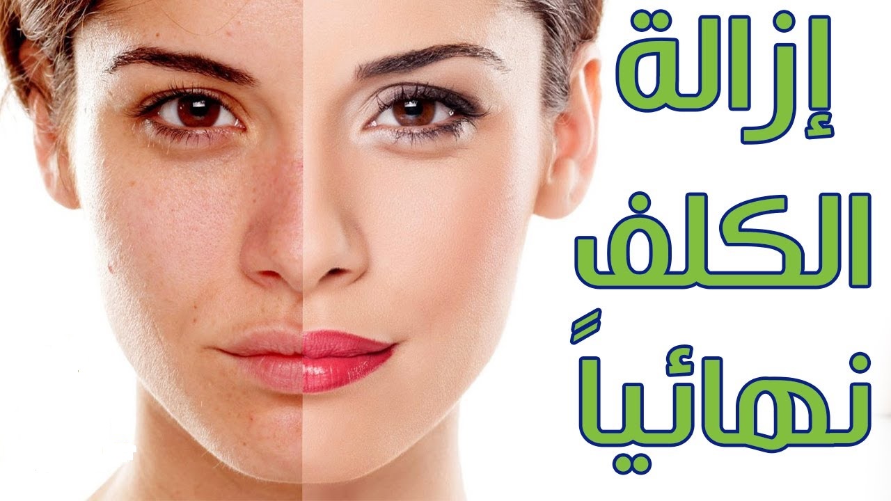 علاج طبيعي للكلف