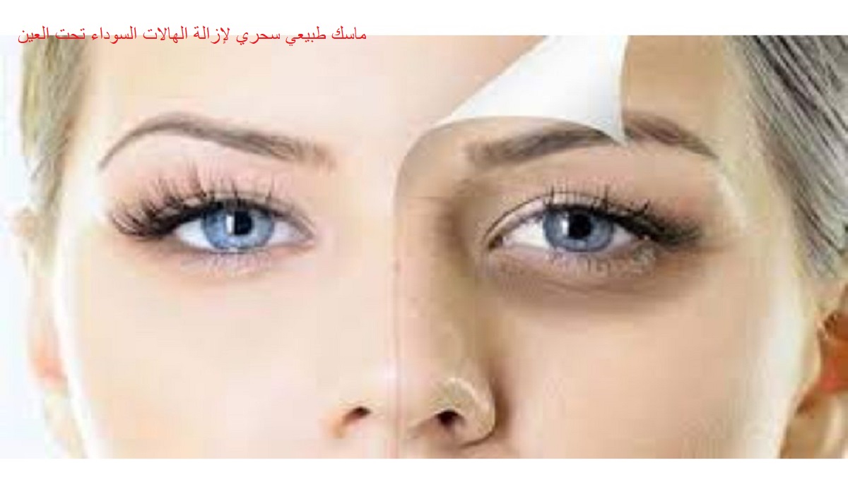 التخلص من الهالات السوداء