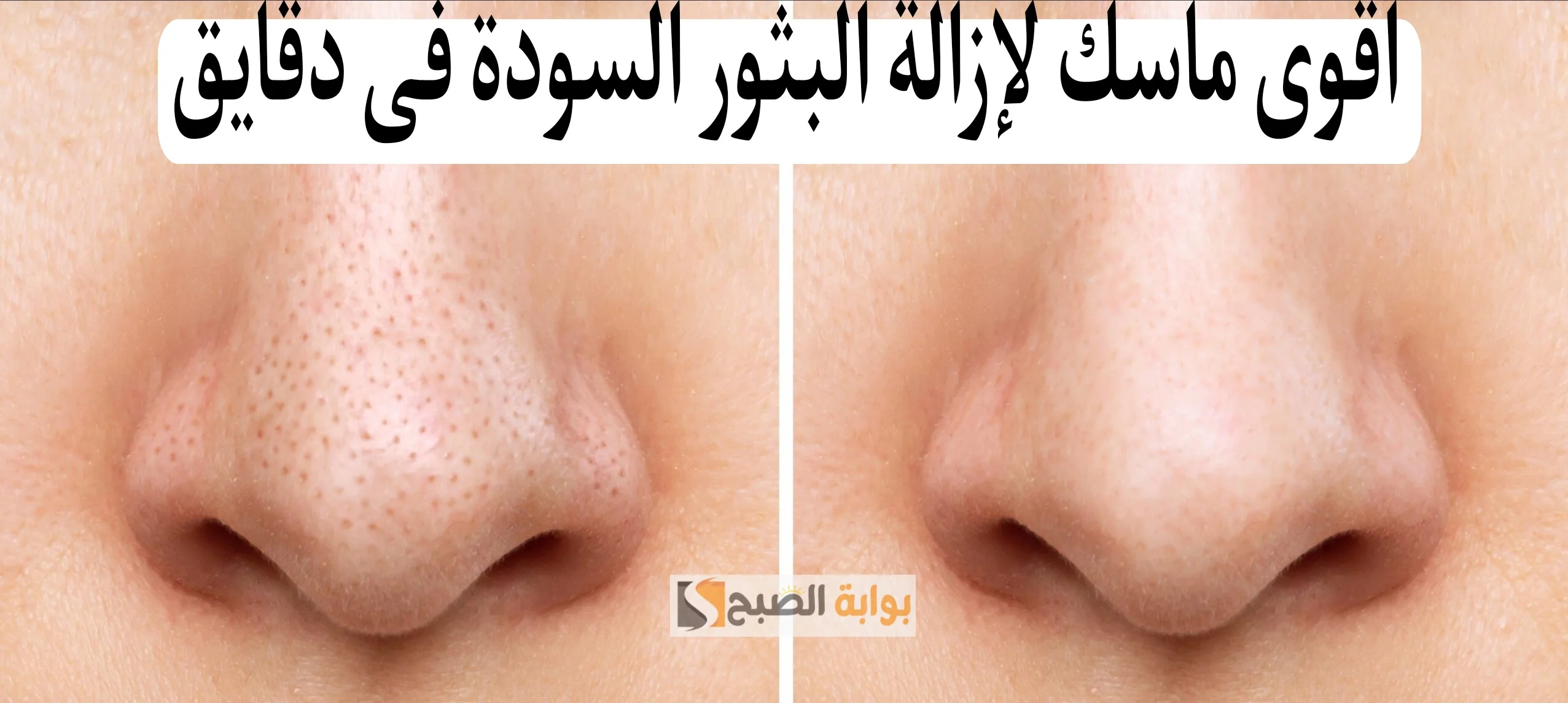 ماسك لإزالة البثور السوداء