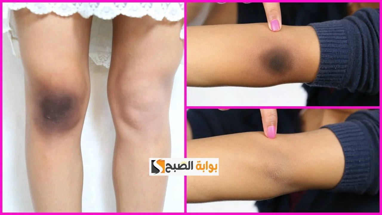 وصفة السكر والقهوة لتقشير الركب و الأكواع