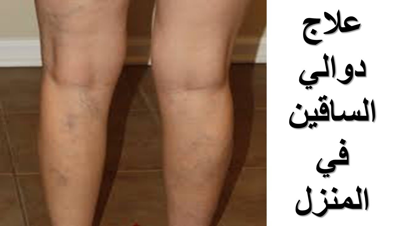 وصفة الطماطم لعلاج الدوالي