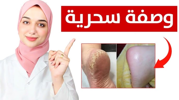 وصفة تشقق القدمين