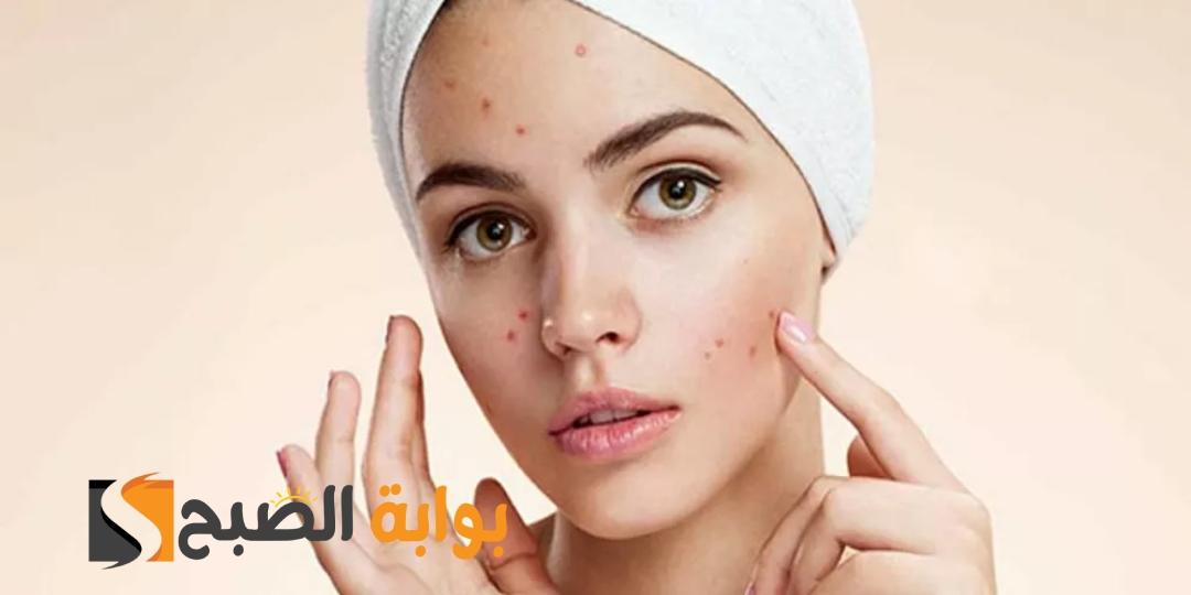 وصفة لإزالة الحبوب من الوجه في يوم واحد