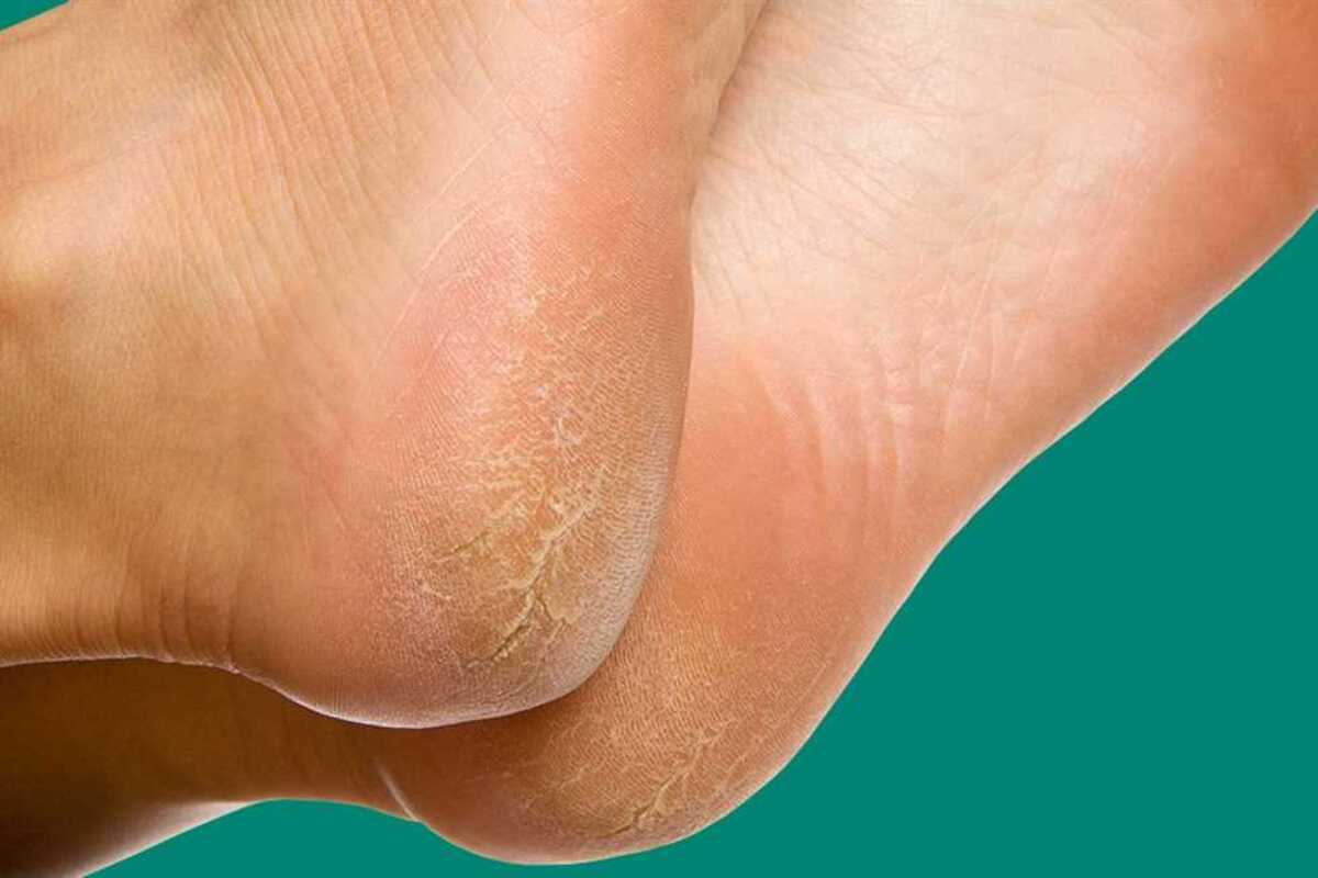 وصفات طبيعية للتخلص من تشققات الكعبين