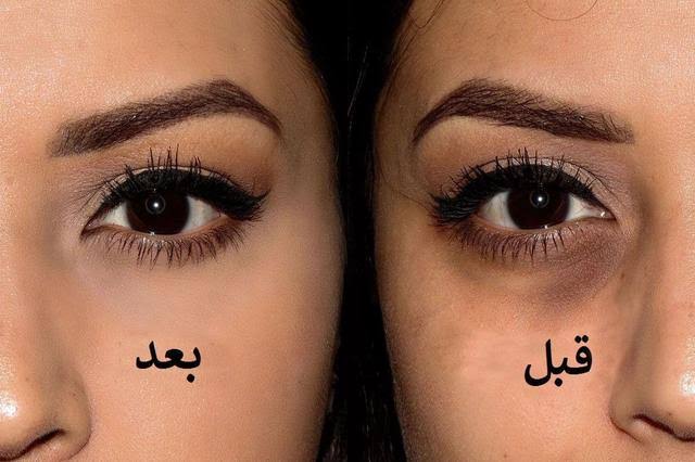 وصفات للقضاء على الهالات السوداء