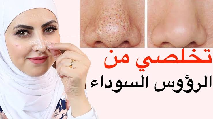 وصفة الشوفان للقضاء على الرؤوس السوداء